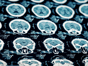 MRI of the Brain