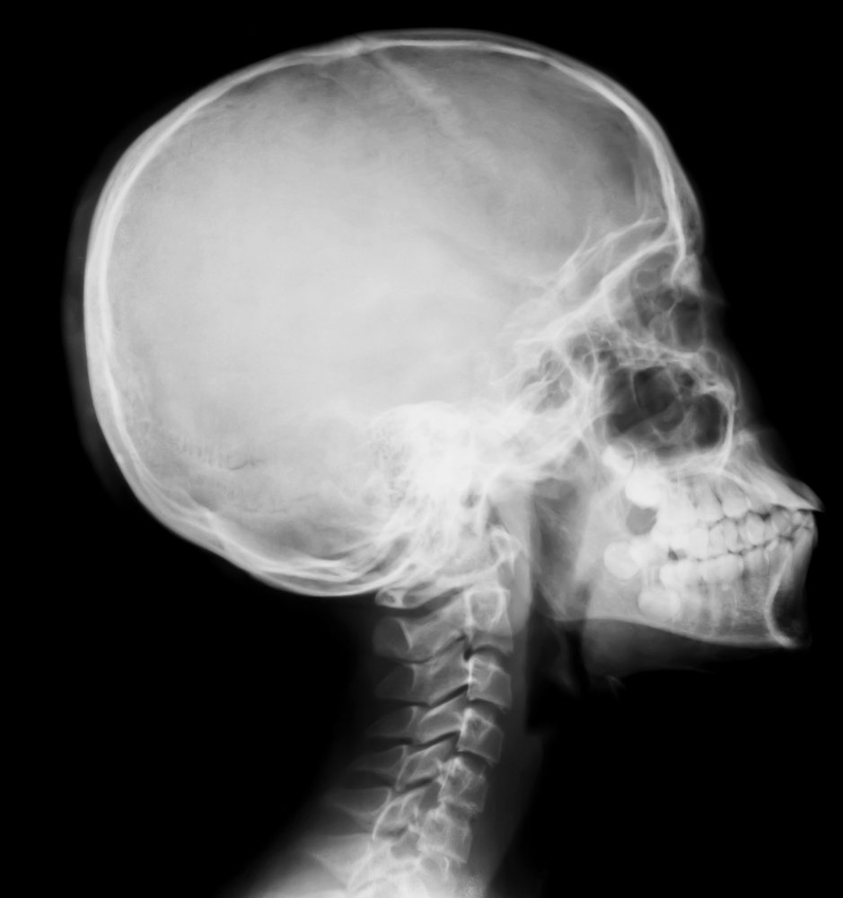 skull fracture xray